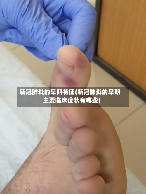 新冠肺炎的早期特征(新冠肺炎的早期主要临床症状有哪些)-第2张图片